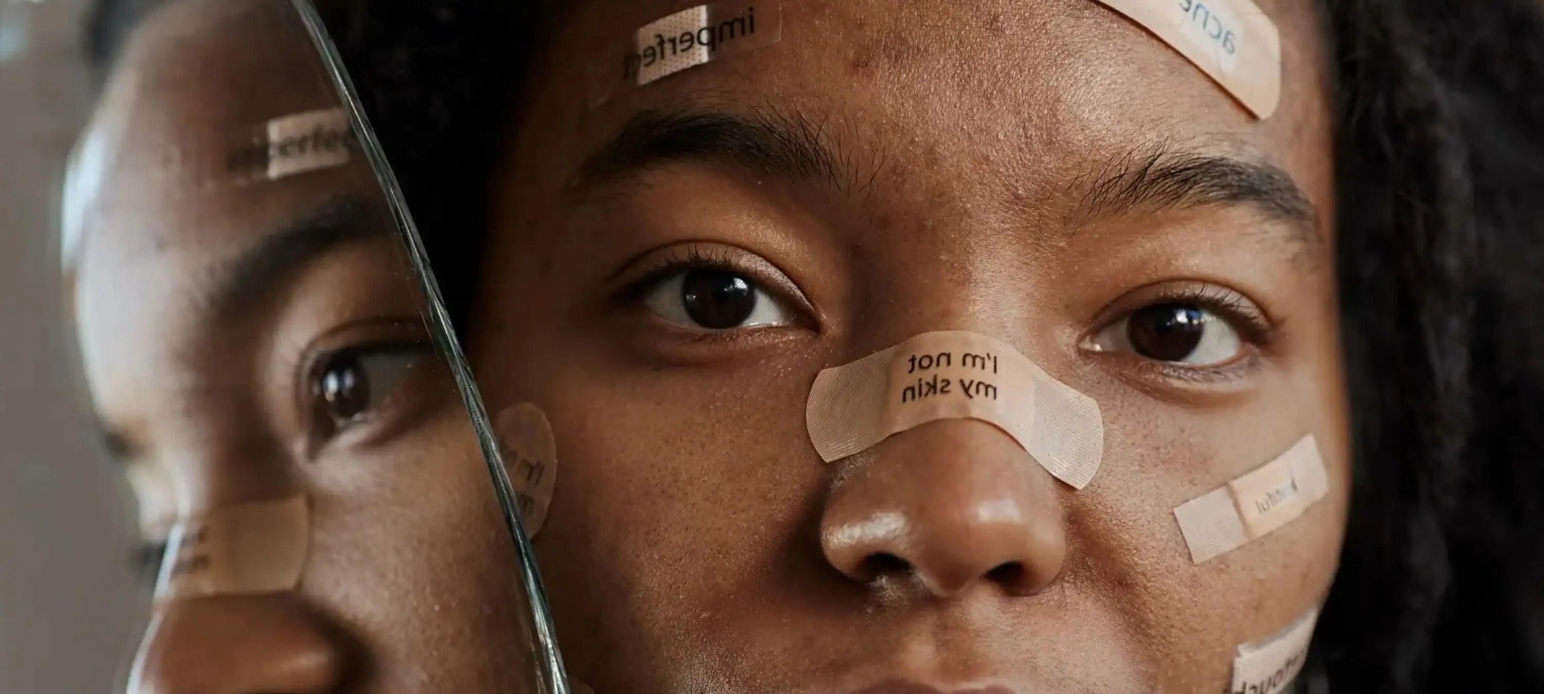 Ein Hormonzyklus im Ungleichgewicht kann Hautprobleme und Akne verstärken, was zu Narben führen kann.