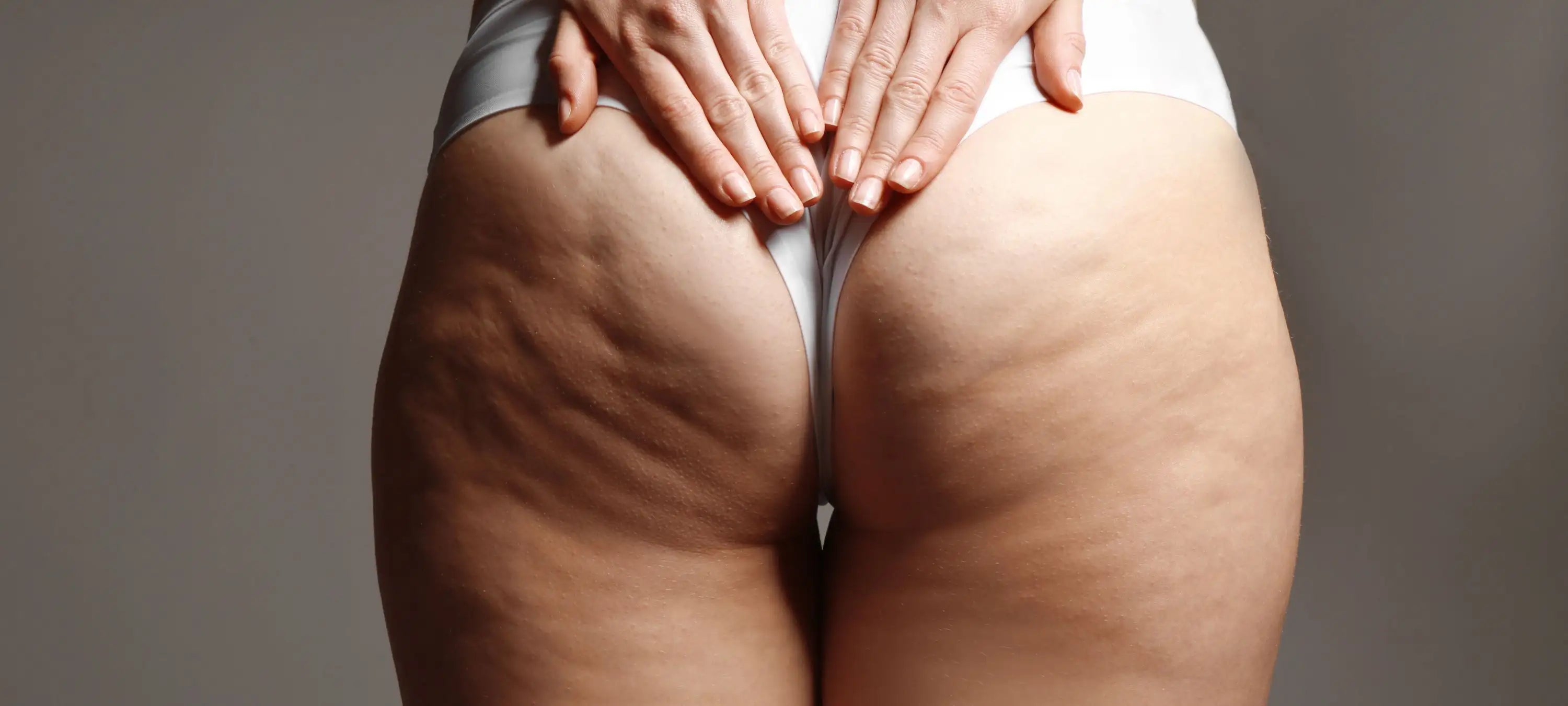 Cellulite sind natürlich und oft genetisch bedingt.